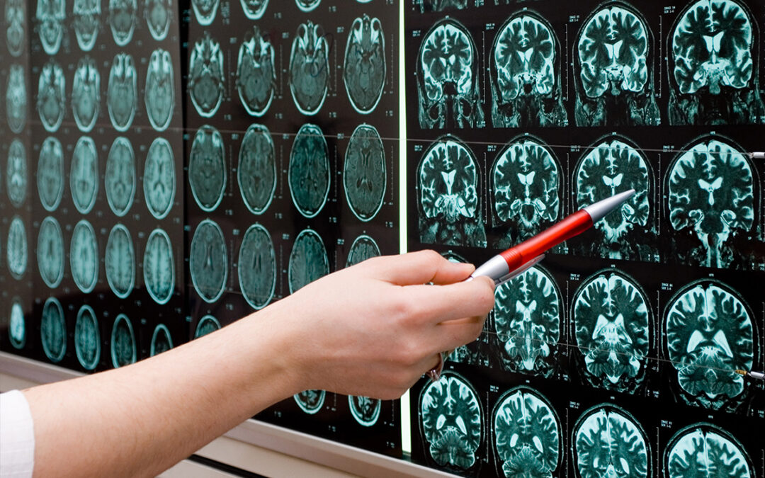 Gli ultrasuoni sono la nuova Frontiera nel trattamento dell’Alzheimer e delle dipendenze?